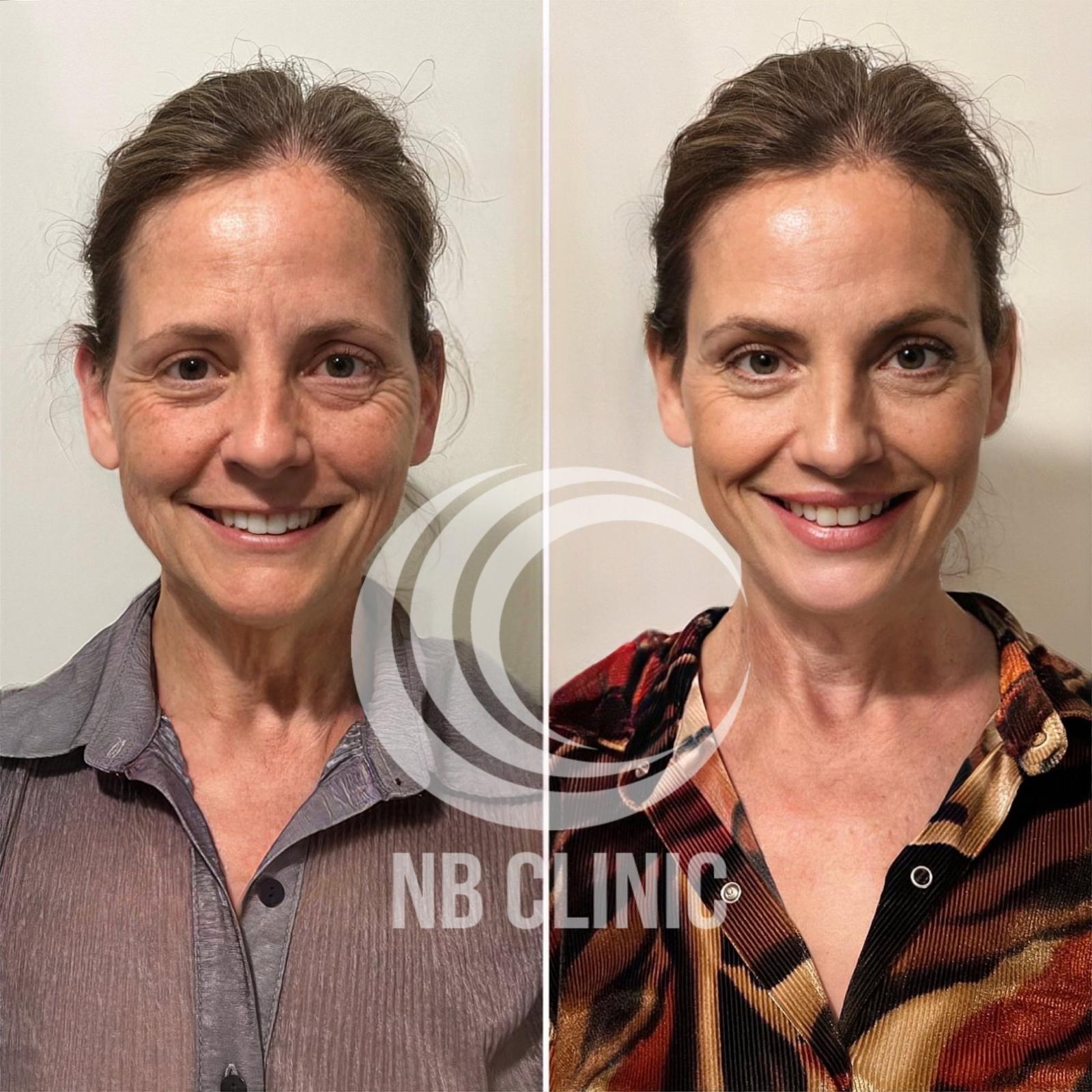 Resultado natural de rejuvenescimento facial