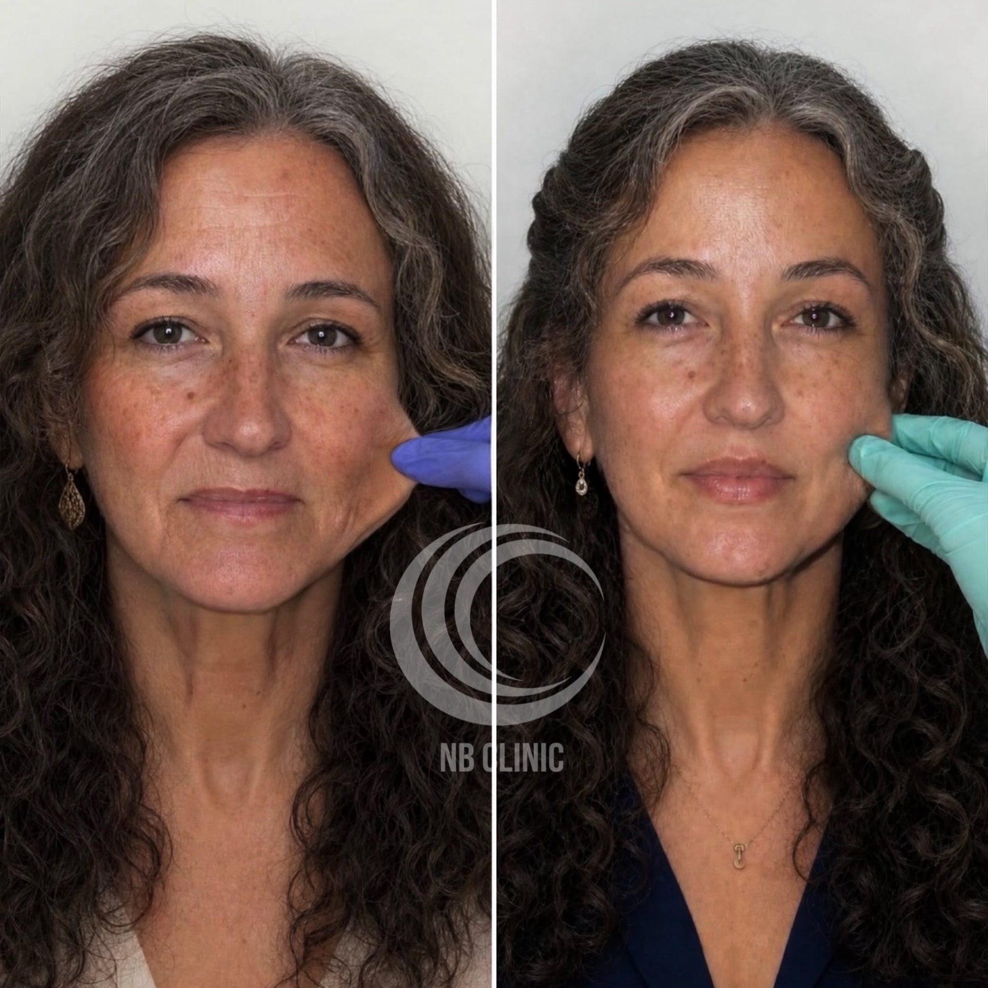 Resultado de harmonização do contorno facial — vista frontal