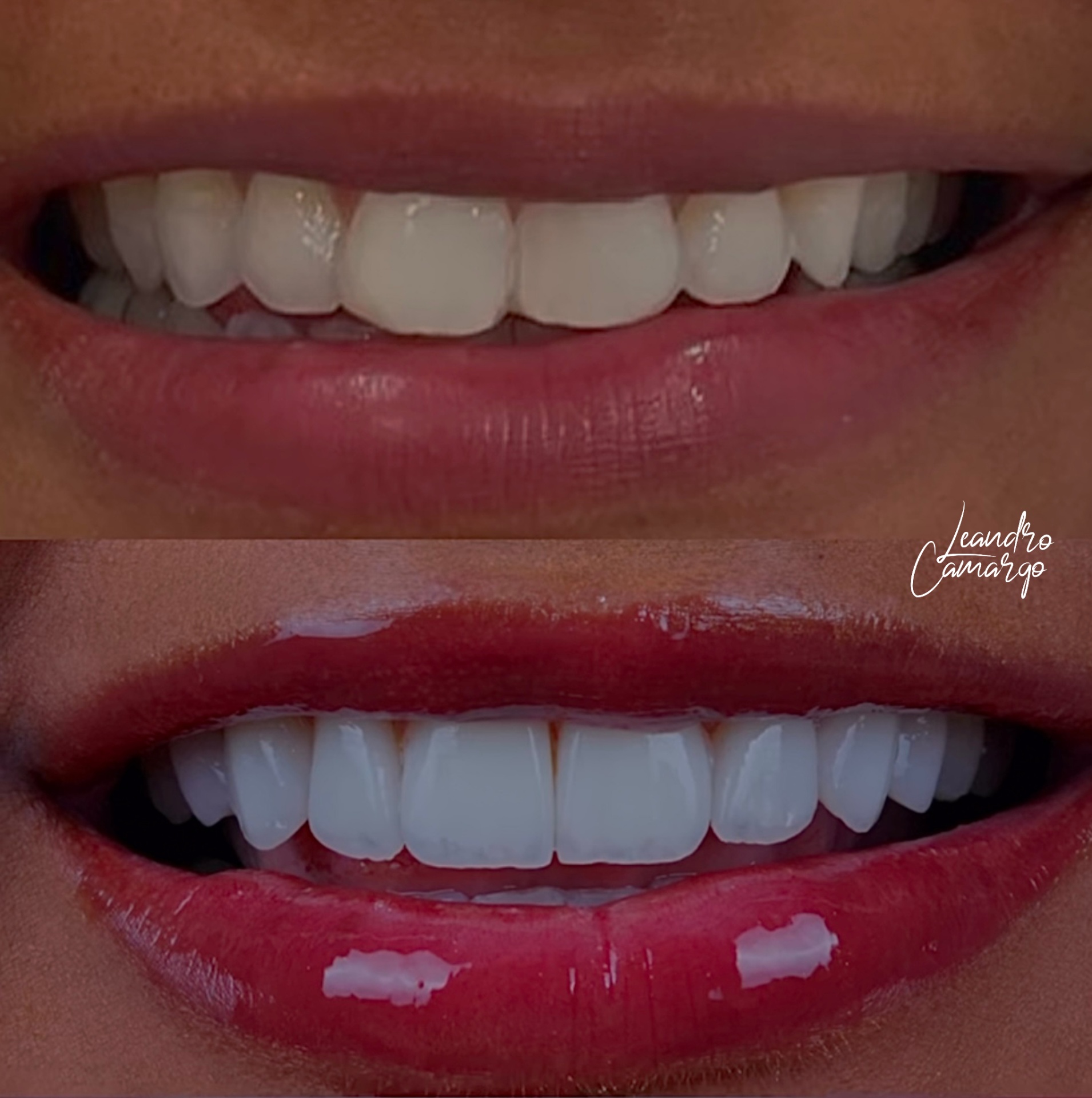 Facetas Dentárias