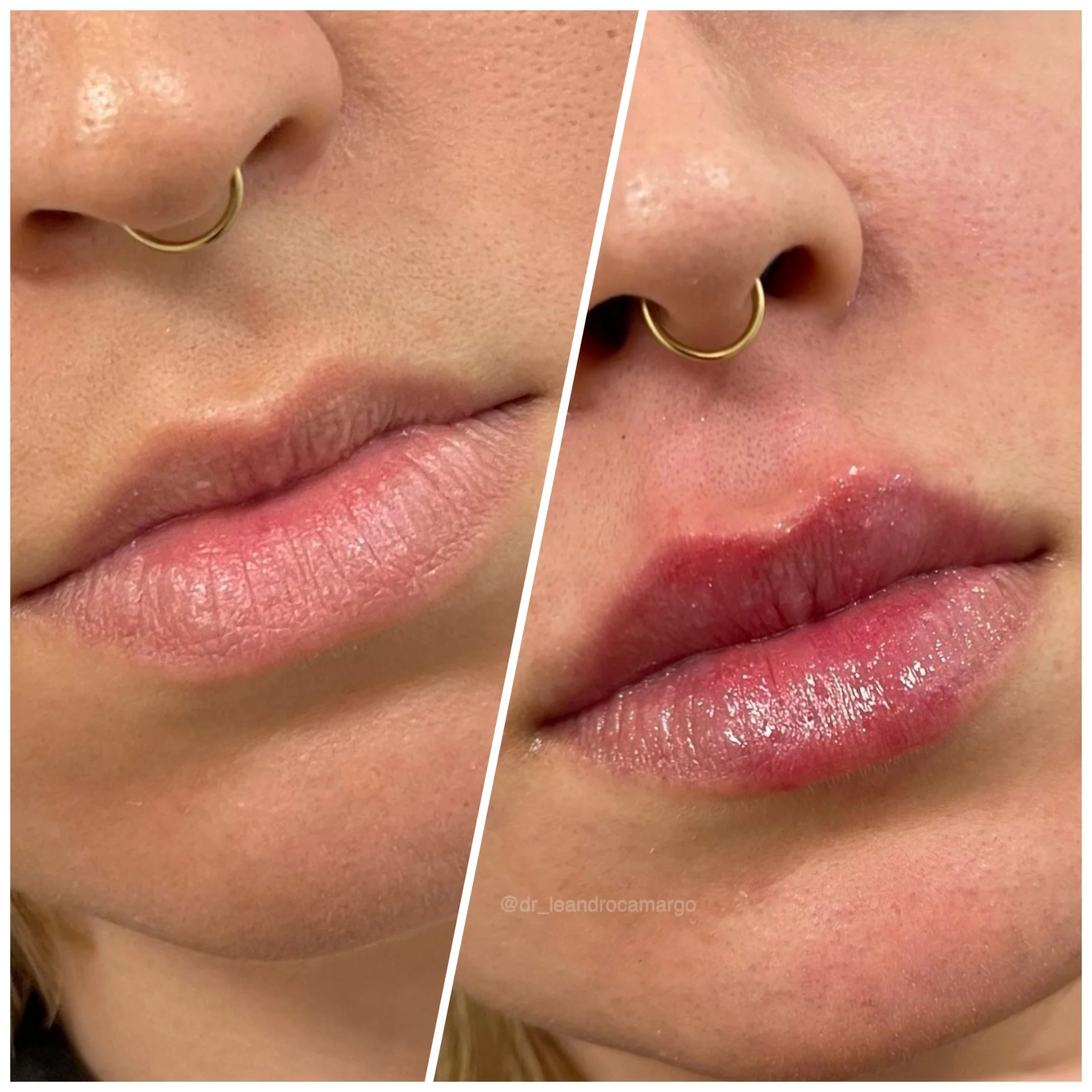 Harmonização Facial