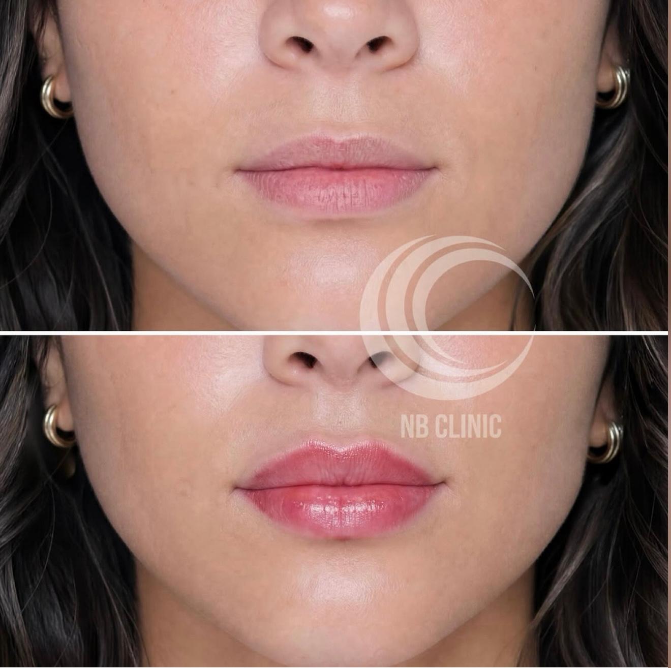 Resultado de harmonização labial
